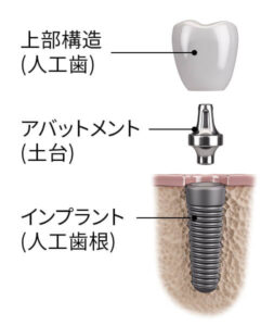 インプラントの構造
