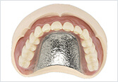 コバルトクロム金属床義歯（片顎）