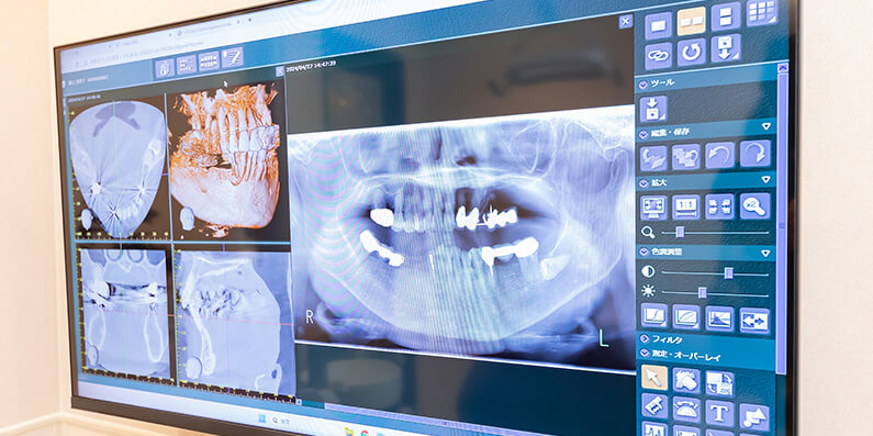 歯科用CTを活用した安全なインプラント治療