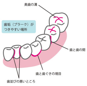 歯垢（プラーク）がつきやすい場所