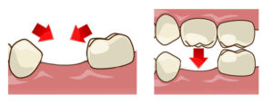 抜けた歯を放置するリスク