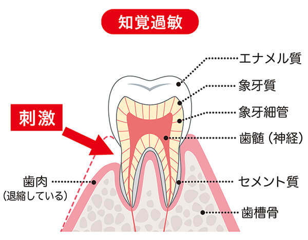 知覚過敏とは